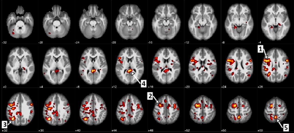 Image: Regions of the brain that showed a statistically significant difference between patients with schizophrenia and patients without it (Photo courtesy of the University of Alberta).