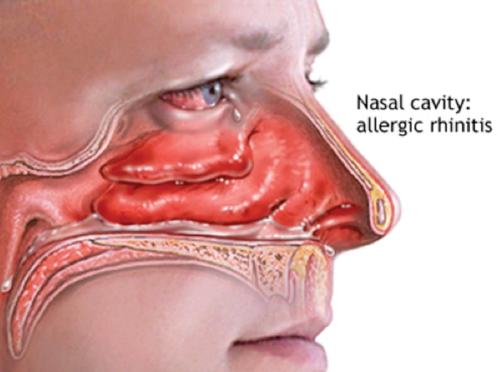 Image: Allergic rhinitis or hay fever is a type of inflammation in the nose, which occurs when the immune system overreacts to allergens in the air (Photo courtesy of US National Institutes of Health).
