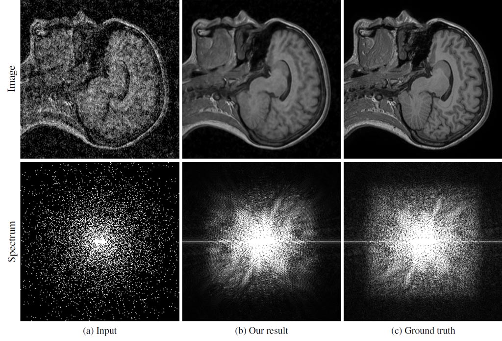 Image: MRI reconstruction example. (a) Input image with only 10% of spectrum samples retained and scaled by 1/p. (b) Reconstruction by a network trained with noisy target images similar to the input image. (c) Original, uncorrupted image (Photo courtesy of NVIDIA).