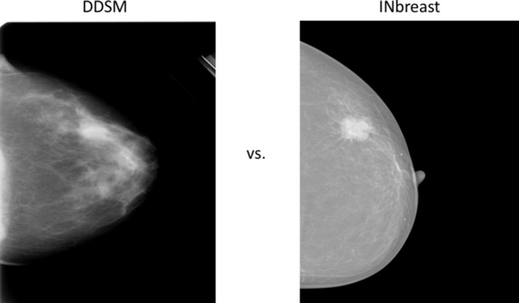 Image: Comparison of two example mammograms from DDSM and INbreast (Photo courtesy of ResearchGate).