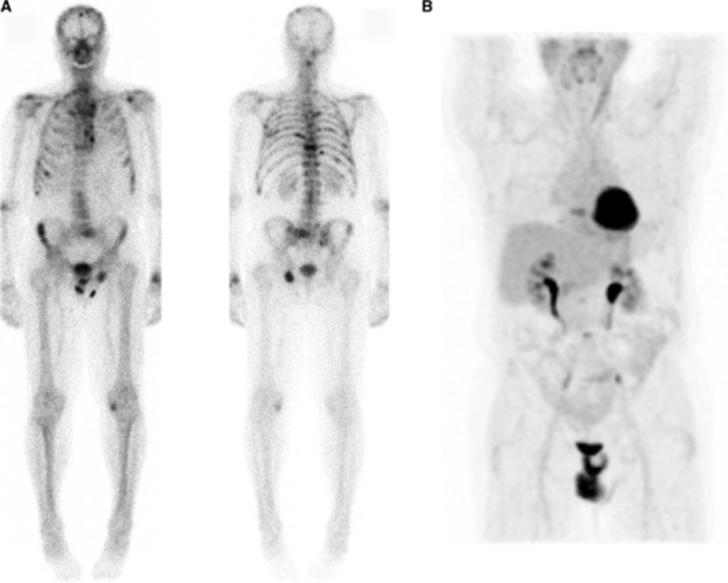 Image: PET imaging can detect breast cancer metastases spread throughout the body (Photo courtesy of NIH). Image: PET imaging can detect breast cancer metastases spread throughout the body (Photo courtesy of NIH).