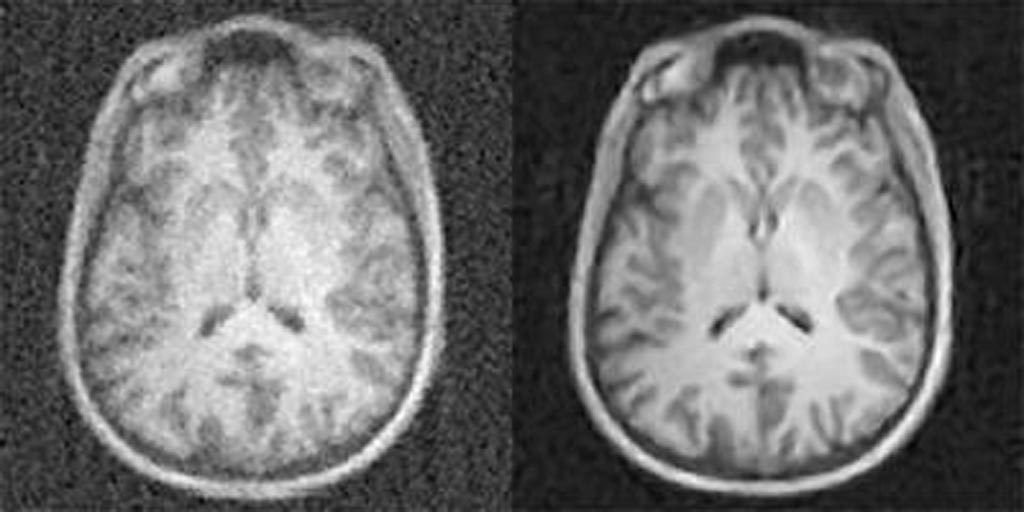 Image: MR images reconstructed from the same data with conventional approaches, at left, and AUTOMAP, at right (Photo courtesy of Athinoula A. Martinos Center for Biomedical Imaging, Massachusetts General Hospital).