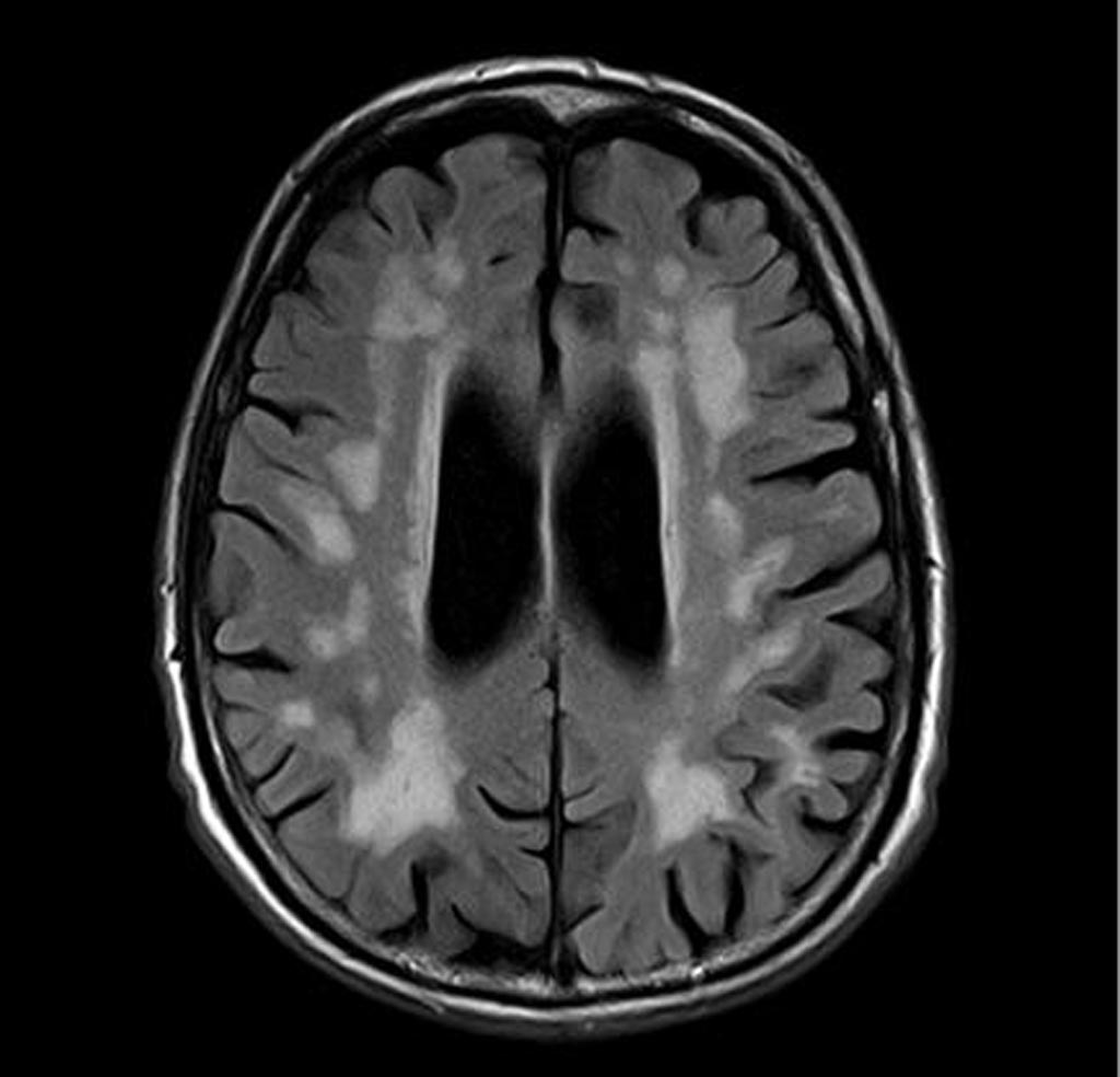 Image: A brain scan showing vascular dementia (Photo courtesy of Radiopaedia).