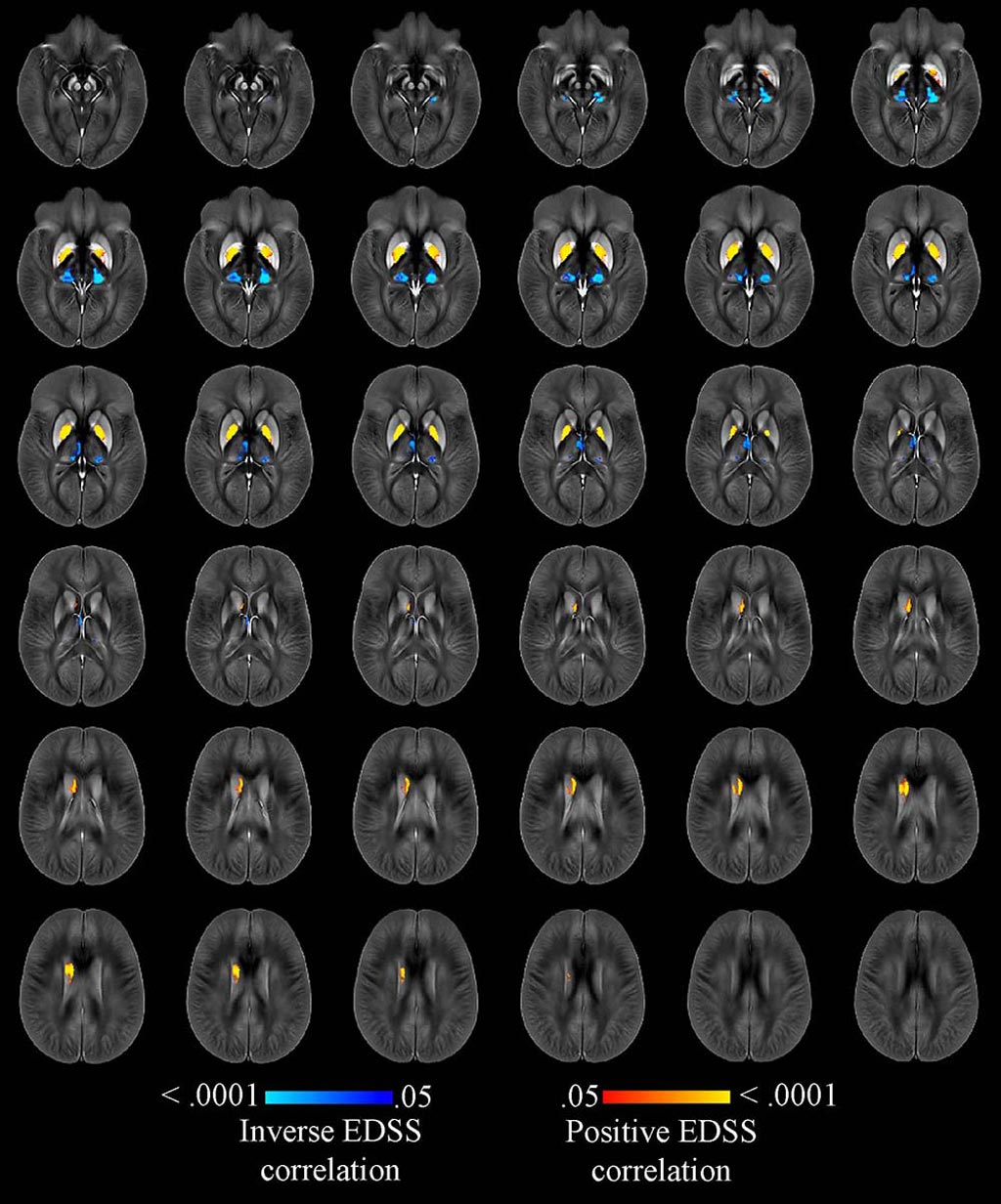 Image: A highly accurate MRI technique can monitor iron levels in the brains of MS patients (Photo courtesy of RSNA). Image: A highly accurate MRI technique can monitor iron levels in the brains of MS patients (Photo courtesy of RSNA).