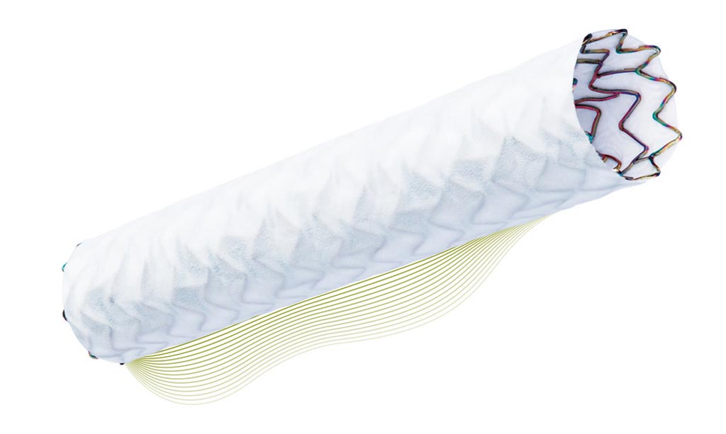 Image: An innovative cardiac stent saves lives by sealing PCI perforations (Photo courtesy of Biotronik).