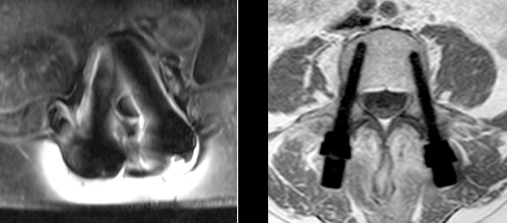 Image: An MRI of titanium pedicle screws (L) and CarboClear pedicle screws (R) (Photo courtesy of CarboFix).