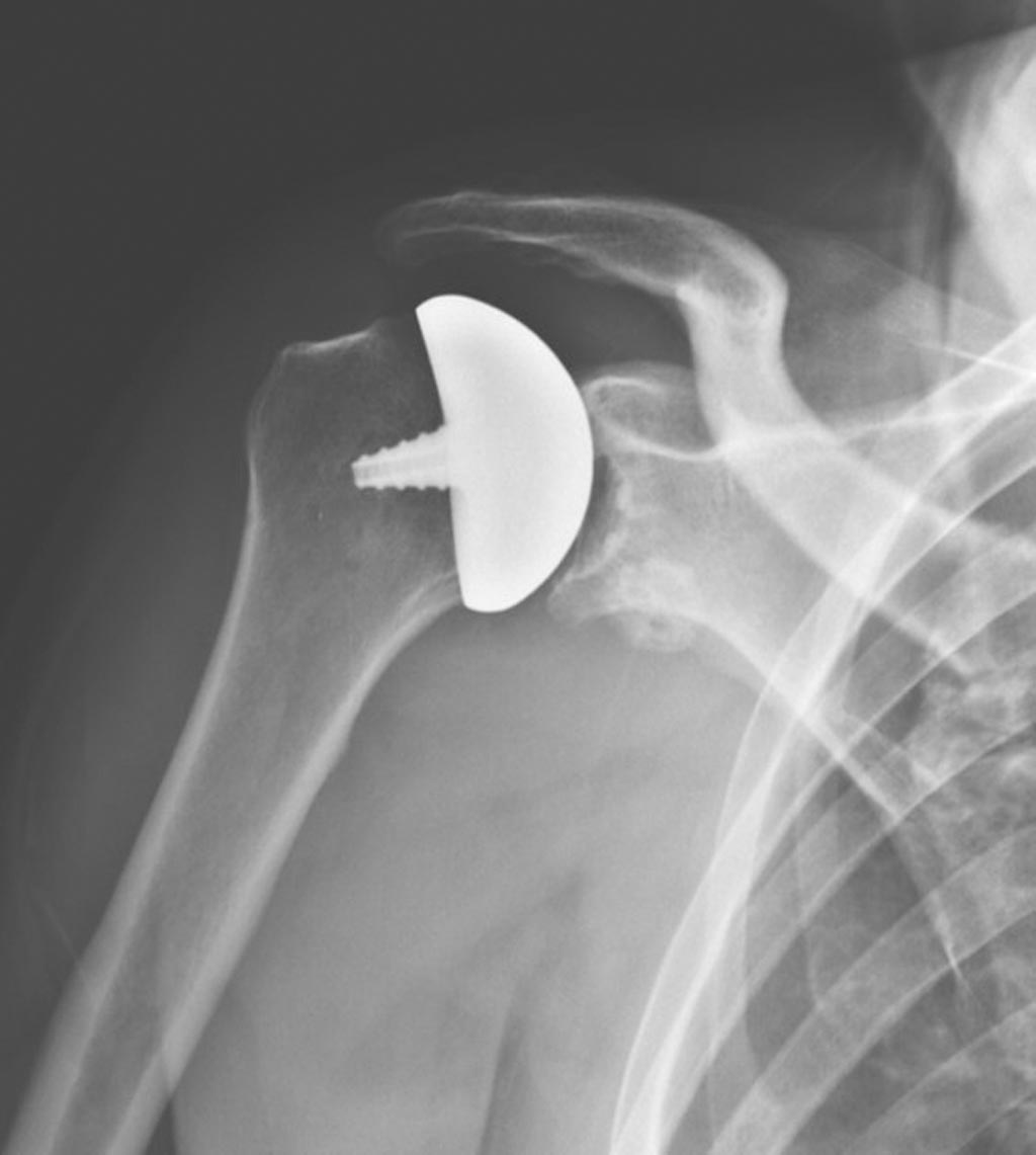 Image: An x-ray image of the stemless OVOMotion implant system (Photo courtesy of Arthrosurface).
