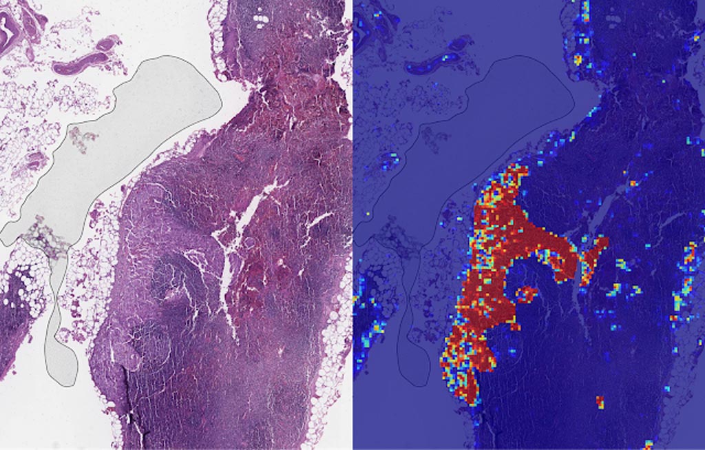 Image: Left: sample view of a slide containing lymph nodes, with multiple artifacts: the dark zone on the left is an air bubble, the white streaks are cutting artifacts, the red hue across some regions are hemorrhagic (containing blood), the tissue is necrotic (decaying), and the processing quality was poor. Right: LYNA identifies the tumor region in the center (red), and correctly classifies the surrounding artifact-laden regions as non-tumor (blue) (Photo courtesy of Google AI).