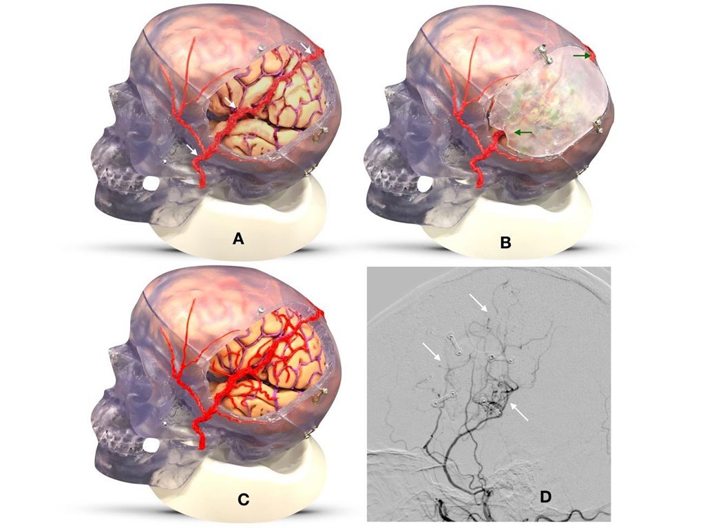 Image: EDAS surgery reroutes scalp arteries to provide new pathways for brain circulation (white arrows) (Photo courtesy of Cedars-Sinai).