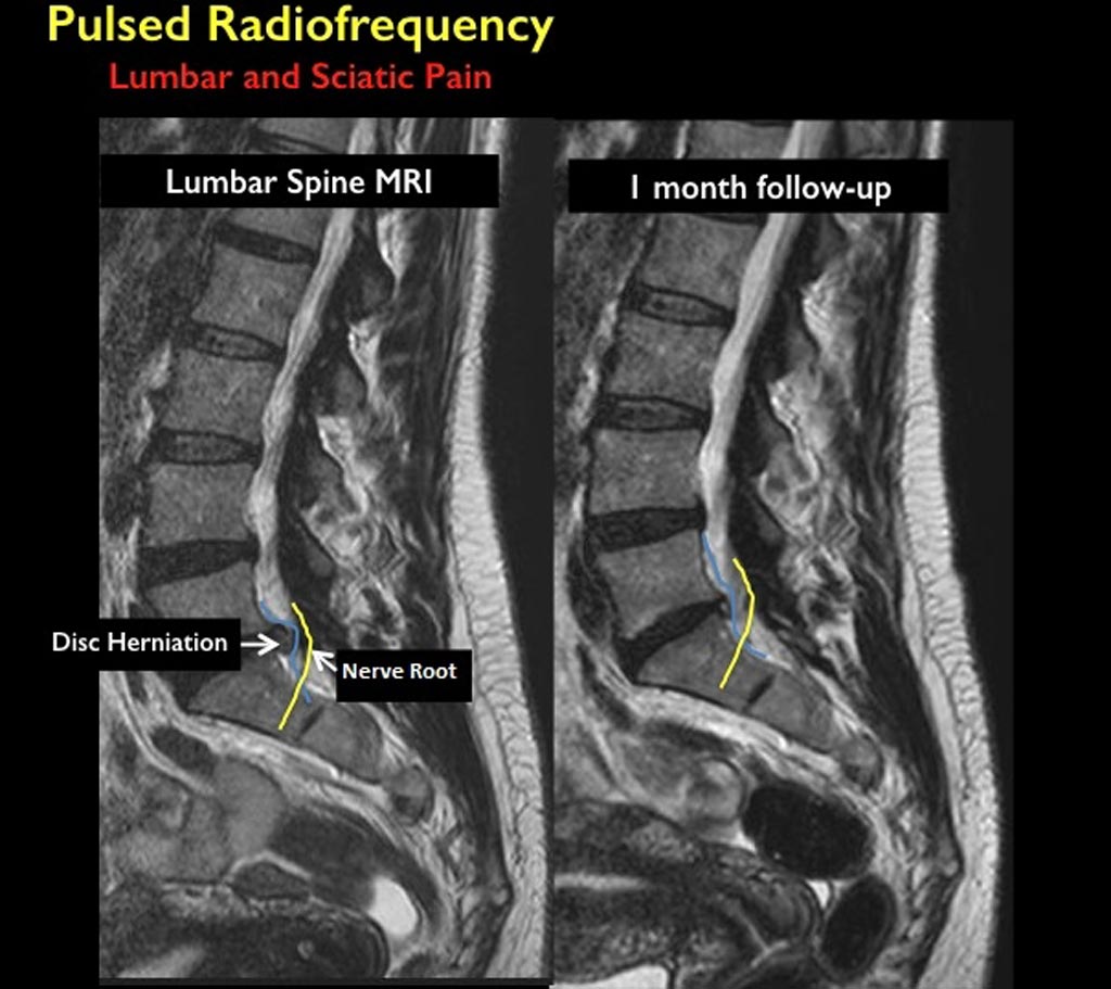 Image: Image of a herniated disc before treatment and at one-month follow-up (Photo courtesy of RSNA).