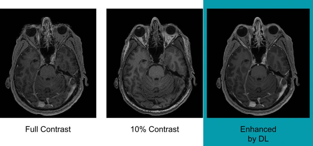 Image: Example of full-dose, 10 percent low-dose and algorithm-enhanced low-dose (Photo courtesy of RSNA).