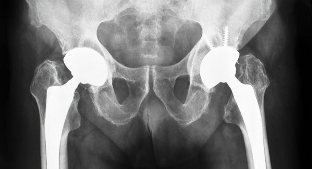 Image: The Hip Implant Prosthesis Study (HIPS) has shown that the older the patient, the more likely cemented metal-on-plastic hip replacements are cost-effective (Photo courtesy of ODT).
