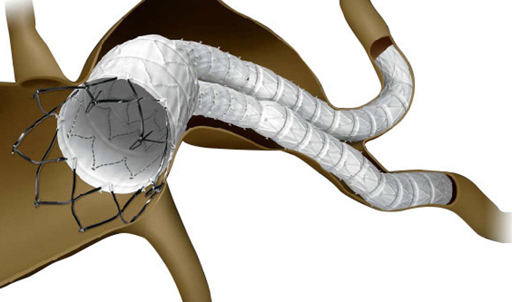 Image: The INCRAFT AAA system is designed to prevent aneurysm rupture (Photo courtesy of Cordis).