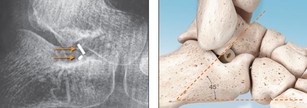 Image: The PitStop Subtalar Implant is made of PEEK, rendering it softer than metal implants (Photo courtesy of I2Bones Global).