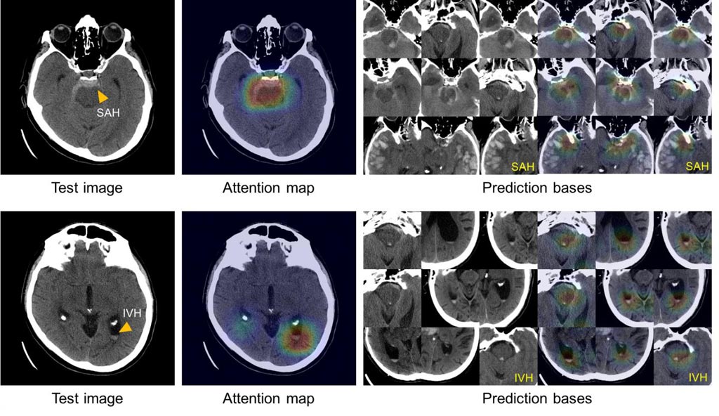 Image: These images show the system’s ability to explain its diagnosis of subarachnoid (left above) and intraventricular (left below) hemorrhage by displaying images with similar appearances (right) from an atlas of images used to train the system (Photo courtesy of Hyunkwang Lee, Harvard School of Engineering and Applied Sciences, and Sehyo Yune, MD, Massachusetts General Hospital Department of Radiology).