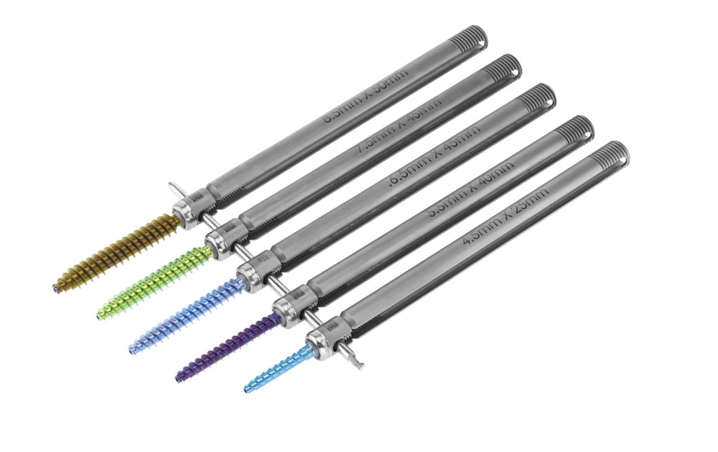 Image: The Europa pedicle screw system comes in five sizes (Photo courtesy of MiRus).