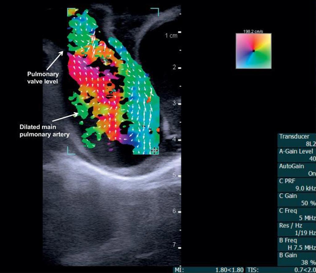 Image: Vector flow imaging demonstrates swirling blood flow (Photo courtesy of Morten Jensen/ UARK). Image: Vector flow imaging demonstrates swirling blood flow (Photo courtesy of Morten Jensen/ UARK).