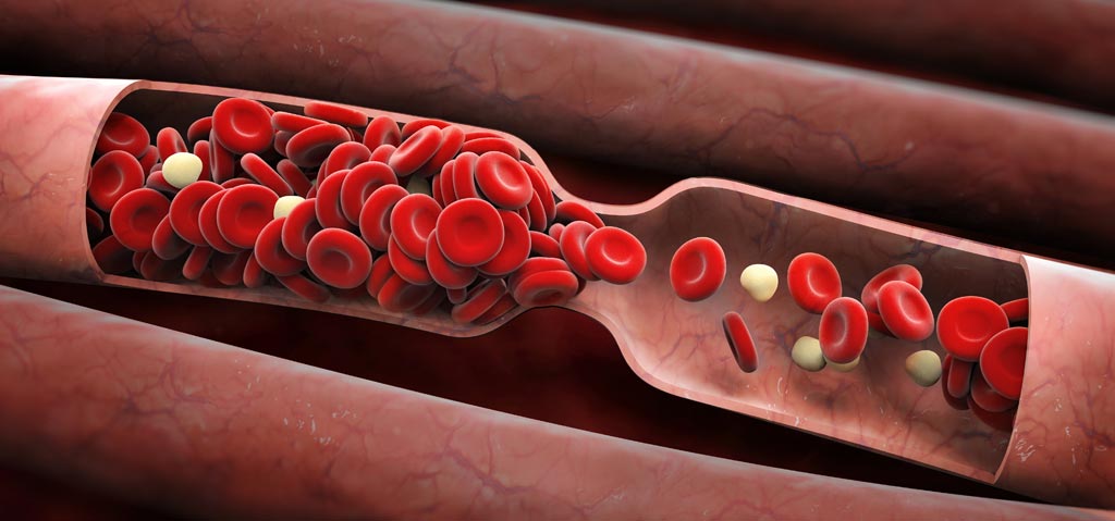 Image: A new study claims blood thinners can reduce potential cardiovascular dangers in HF patients (Photo courtesy of Fotolia).