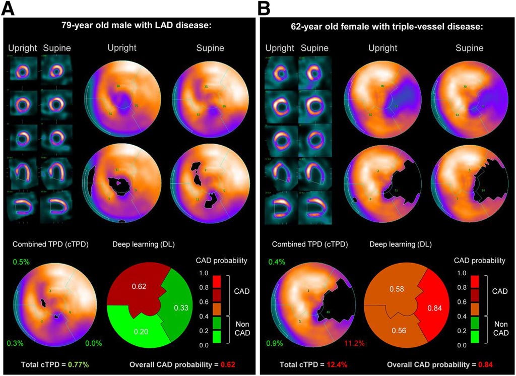 Image: A prediction of obstructive CAD from upright and supine stress MPI. Short/long axis views, polar maps depicting normalized radiotracer count distribution and perfusion defects (top), and predictions by cTPD and DL (bottom) are shown for two patients with obstructive CAD (Photo courtesy of SNMMI). Image: A prediction of obstructive CAD from upright and supine stress MPI. Short/long axis views, polar maps depicting normalized radiotracer count distribution and perfusion defects (top), and predictions by cTPD and DL (bottom) are shown for two patients with obstructive CAD (Photo courtesy of SNMMI).