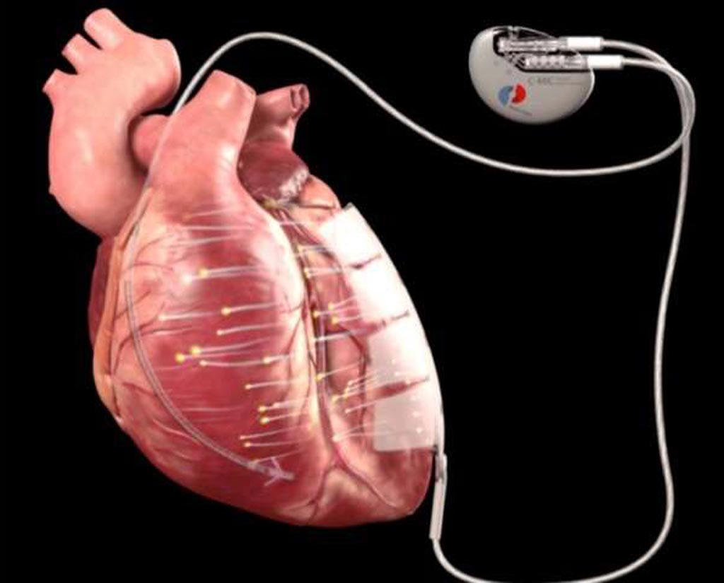 Image: The implanted device is designed to stimulate cell regeneration in cardiomyopathy (Photo courtesy of Berlin Heals).
