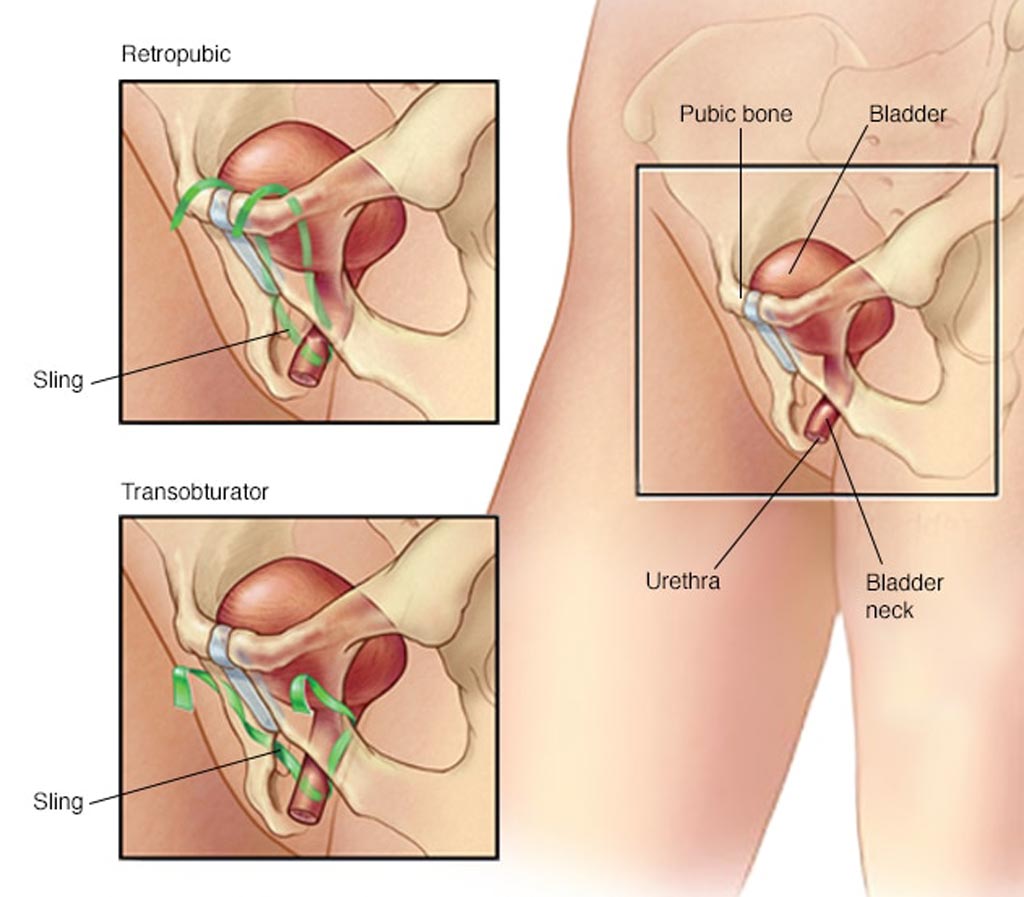 Image: A comparison of the retropubic and transobturator sling procedures (Photo courtesy of the Mayo Clinic).