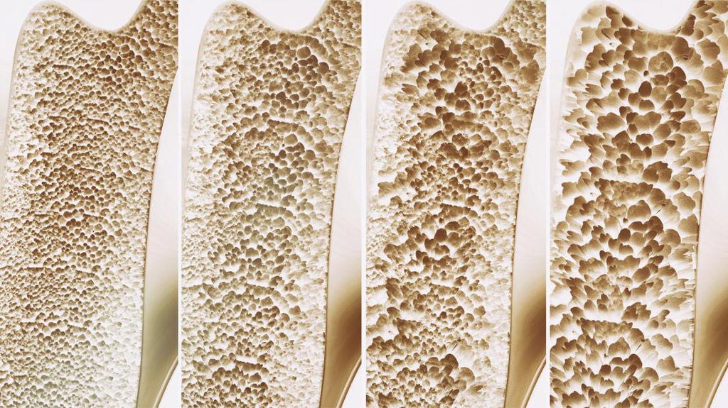 Image: Osteoporotic fractures are the leading cause of hospitalizations in the U.S. (Photo courtesy of Dreamstime).