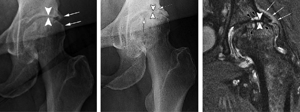 Image: Progressive loss of acetabular and femoral cartilage and subchondral cystic changes after IACS (Photo courtesy of Ali Guermazi Radiology).