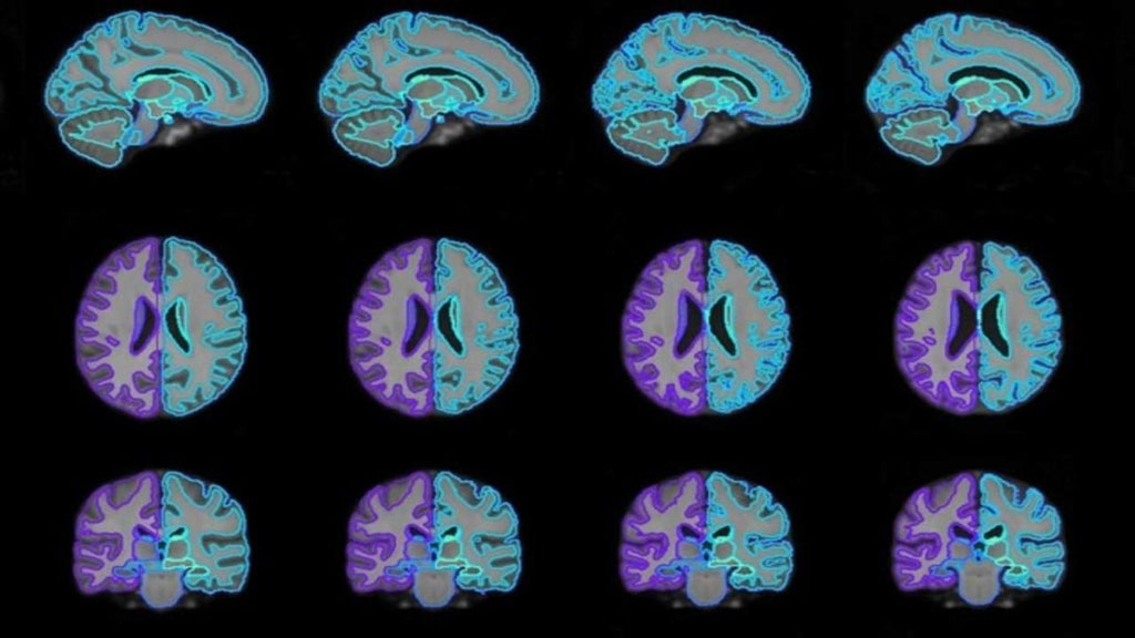 Image: On-demand brain scan templates of various ages generated using the joint CNN platform (Photo courtesy of MIT)