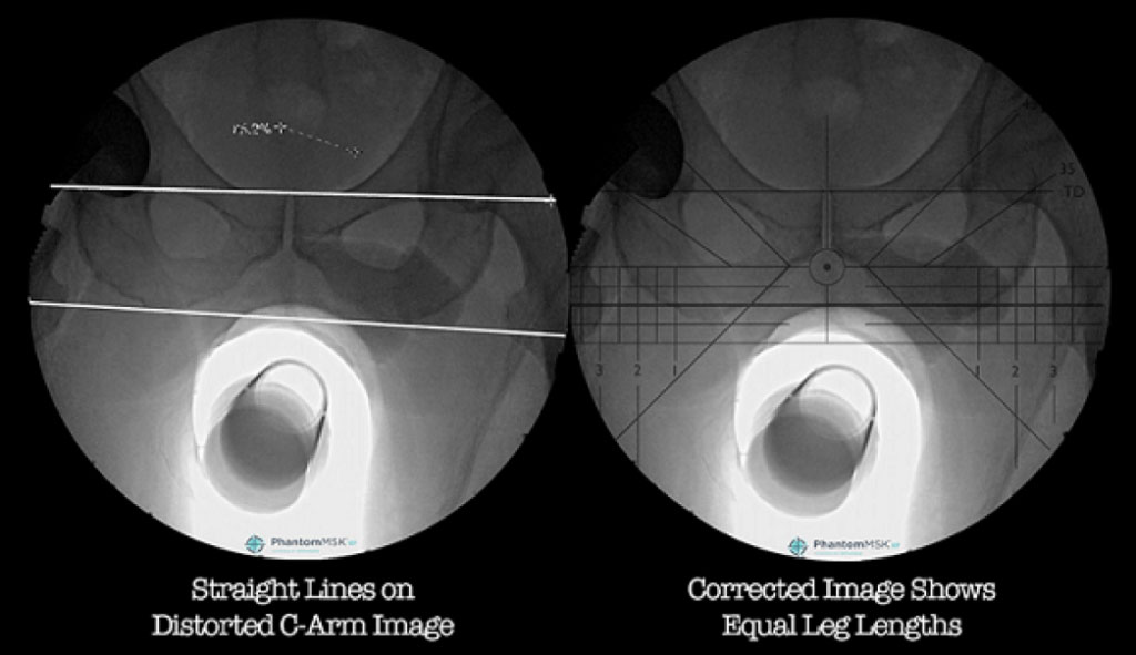 Image: Distorted and corrected hip fluoroscopes using PhantomMSK (Photo courtesy of OrthoGrid Systems)