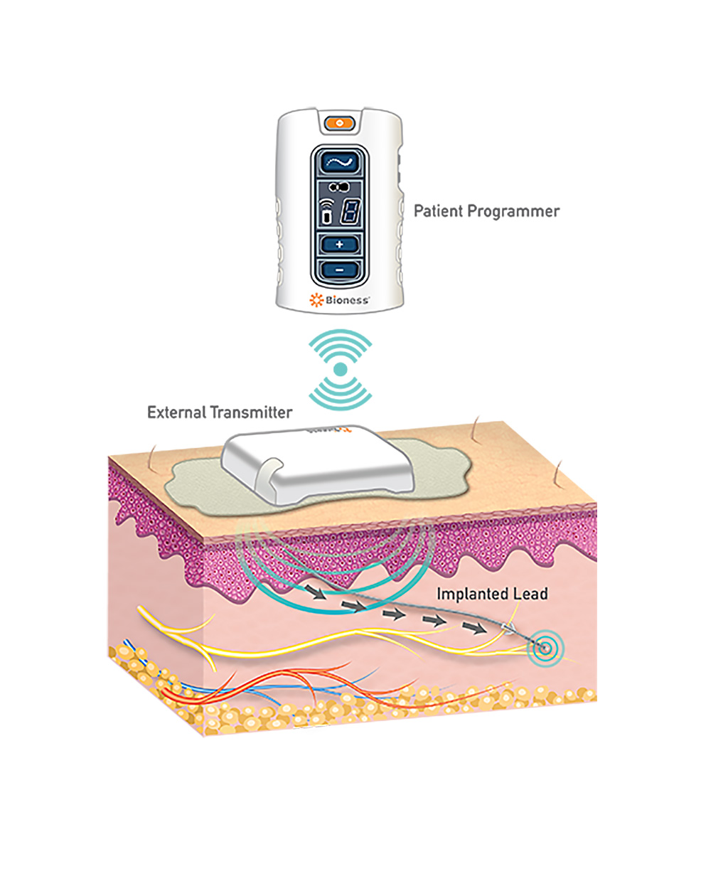 Image: The StimRouter neuromodulation system (Photo courtesy of Bioness)