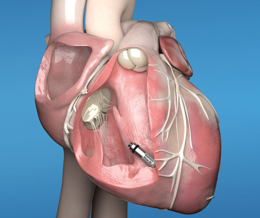 Image: The Micra AV leadless pacemaker with internal atrial sensing algorithms (Photo courtesy of Medtronic)