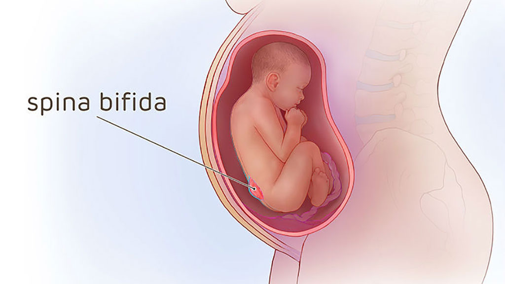 Image: Prenatal spina bifida surgery improves school age function (Photo courtesy of CHOP)