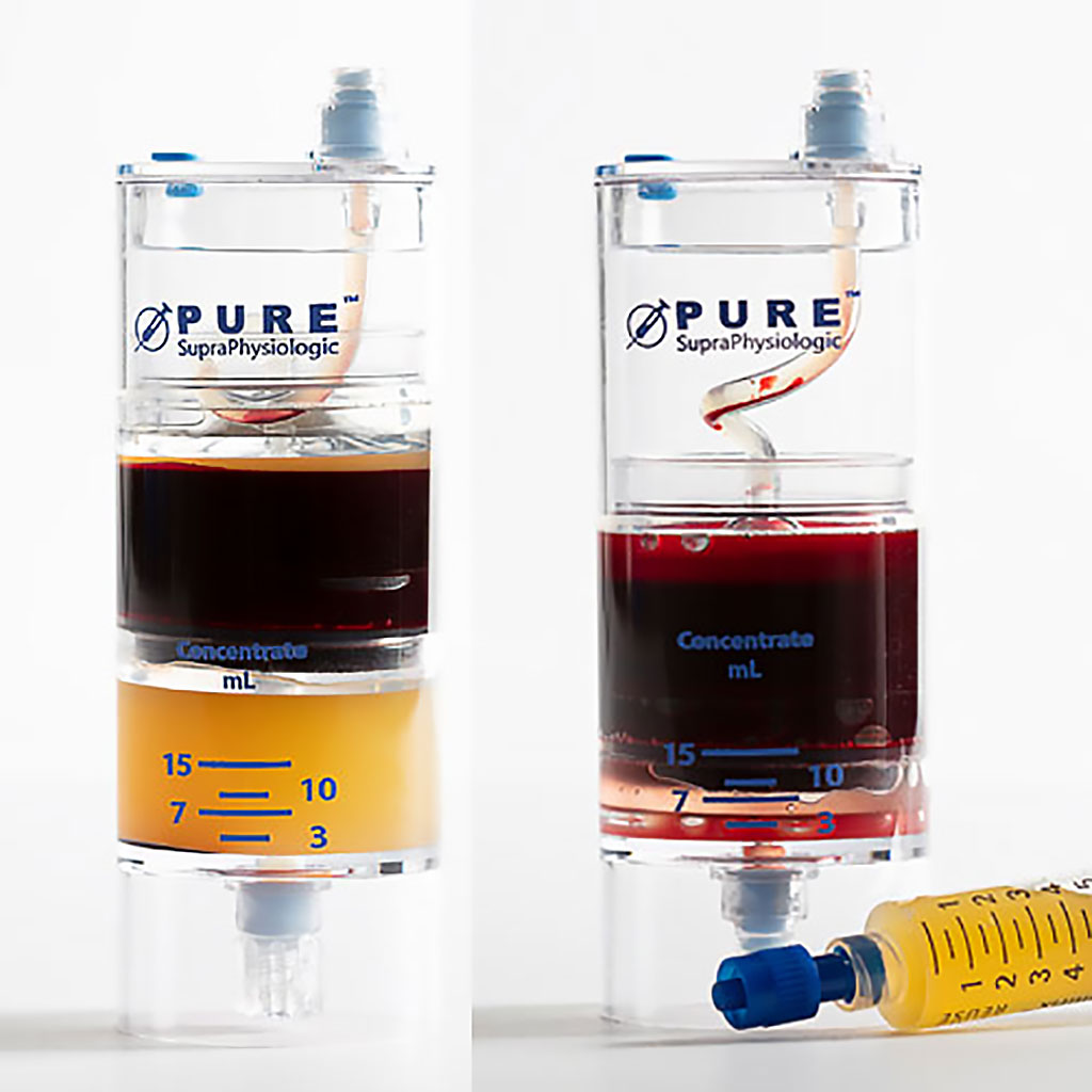 Image: Post centrifugation (R) and the separated PRP aliquot (L) (Photo courtesy of EmCyte Corporation)