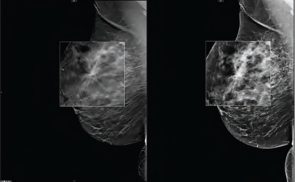 Image: DBT can increase breast cancer detection rates (Photo courtesy of Carestream)
