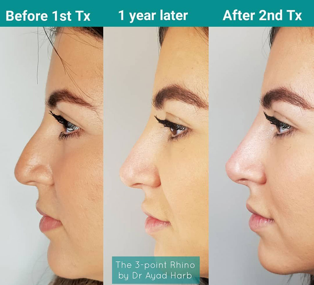 Image: An example of liquid rhinoplasty (Photo courtesy of Dr. Ayad Harb)