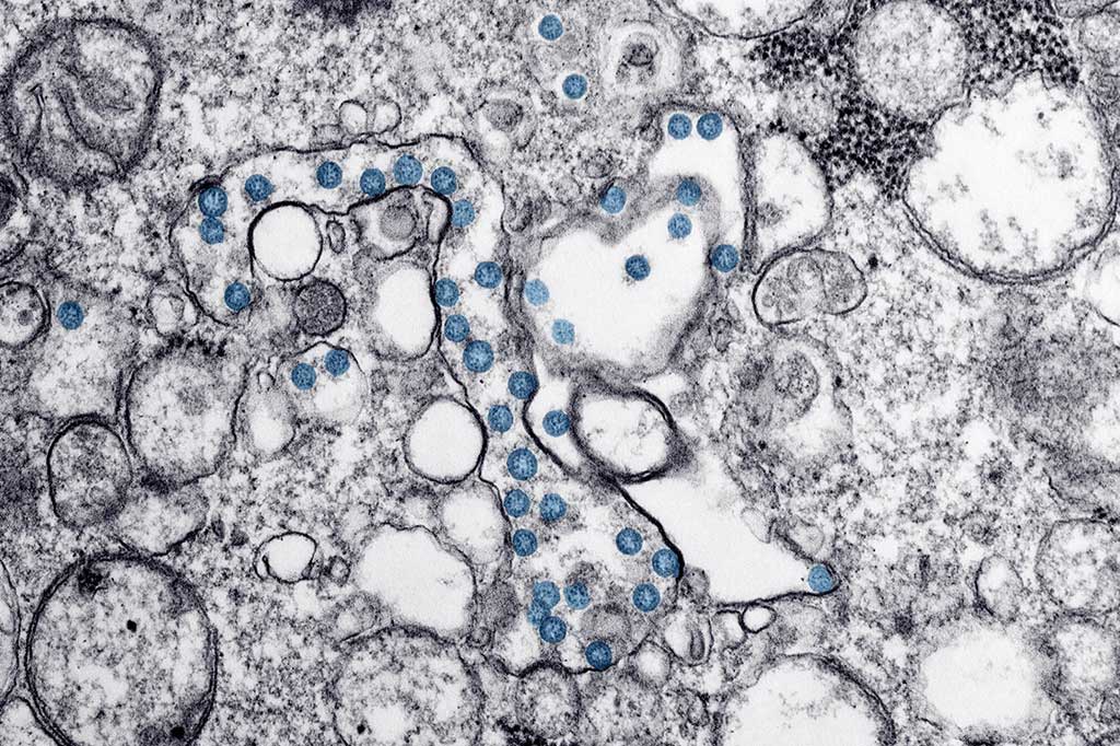 Image: Transmission electron micrograph of an isolate from a case of COVID-19, caused by the coronavirus SARS-CoV-2. The spherical viral particles, colorized blue, contain cross-sections through the viral genome, seen as black dots (Photo courtesy of Hannah A Bullock and Azaibi Tamin).