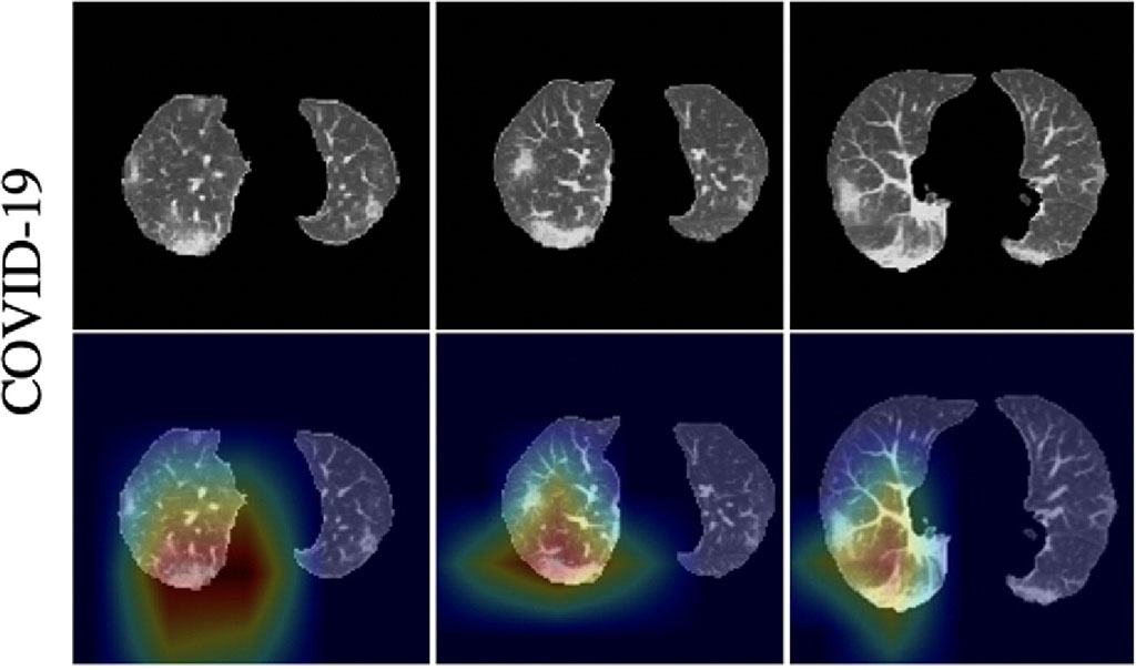 Image: Heatmaps of COVID-19 activation regions (Photo courtesy of Wuhan Huangpi People\'s Hospital)