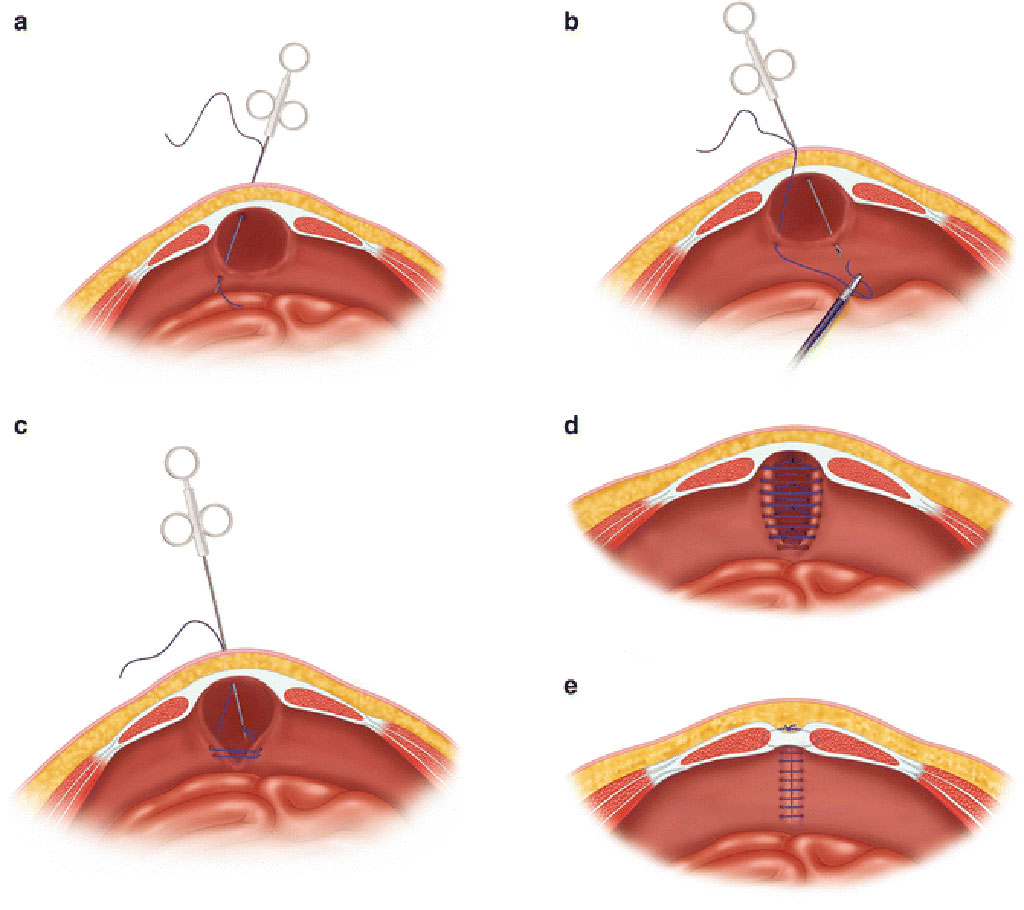 Image: Summary of the primary fascial closure (PFC) procedure (Photo courtesy of UTHSCSA)