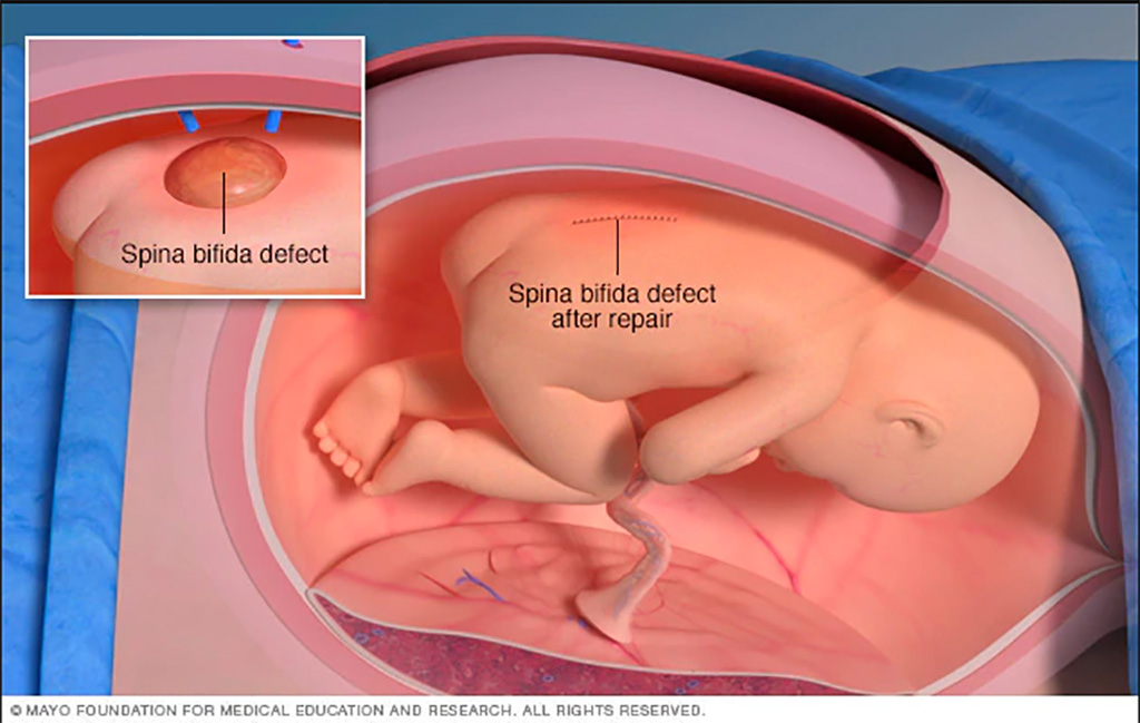 Image: Repairing Spina Bifida can restore brain structure (Photo courtesy of Mayo Clinic)