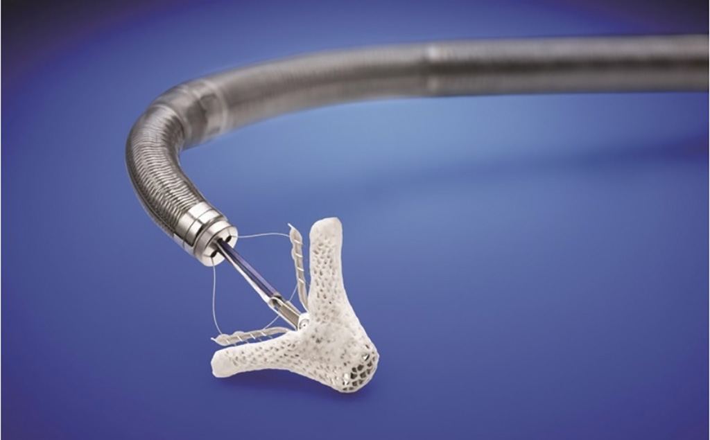 Image: The TriClip transcatheter valve repair device (Photo courtesy of Abbott)