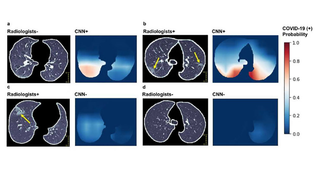 Image: Unique AI Algorithm Analyzes Chest CT Scans and Patient Data to Rapidly Detect COVID-19 (Photo courtesy of BioMedical Engineering and Imaging Institute (BMEII) at the Icahn School of Medicine at Mount Sinai)