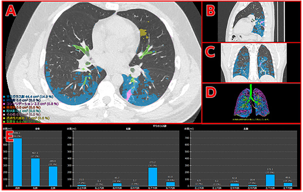 Image: CT images of a patient who has developed pneumonia as a complication of COVID-19 and analysis results (Photo courtesy of Fujifilm Corporation)