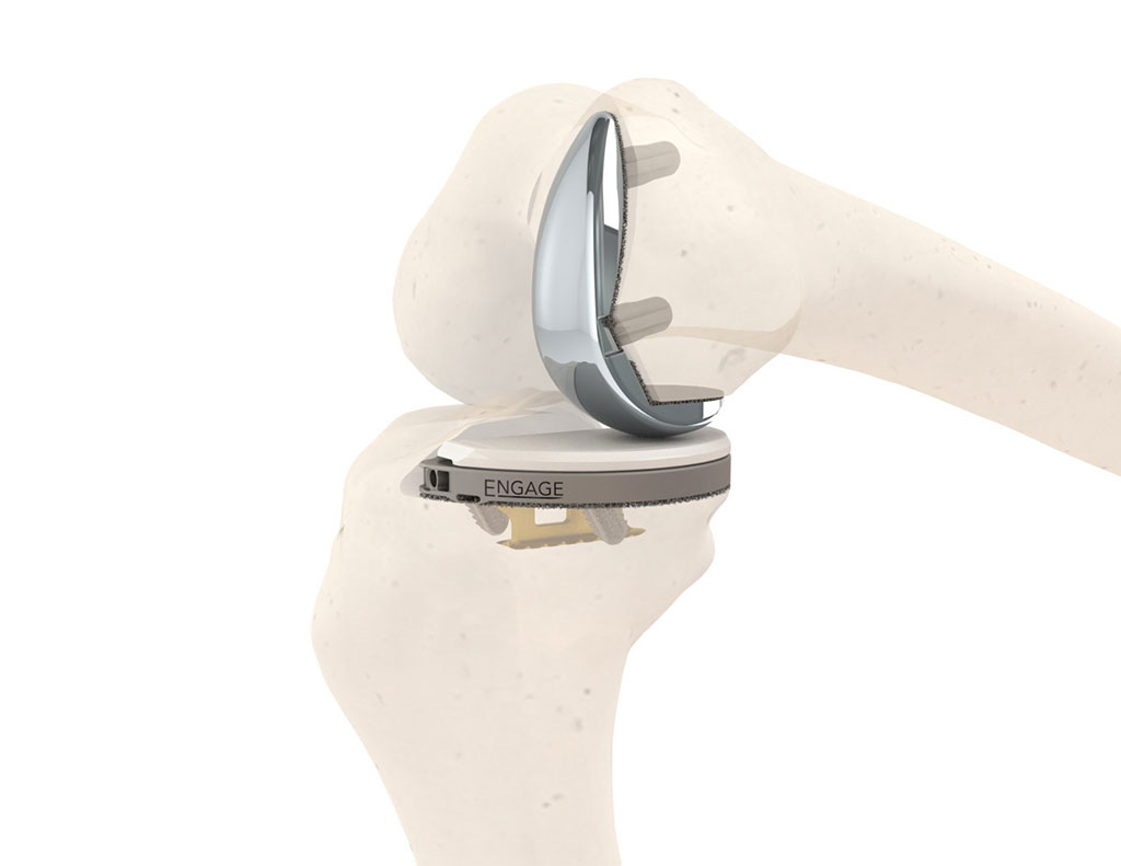 Image: The cementless Engage partial knee system (Photo courtesy of Engage)