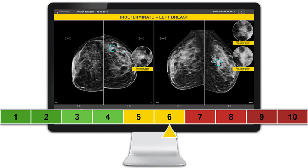 Image: A novel AI platform scores breast cancer malignancy (Photo courtesy of Therapixel)