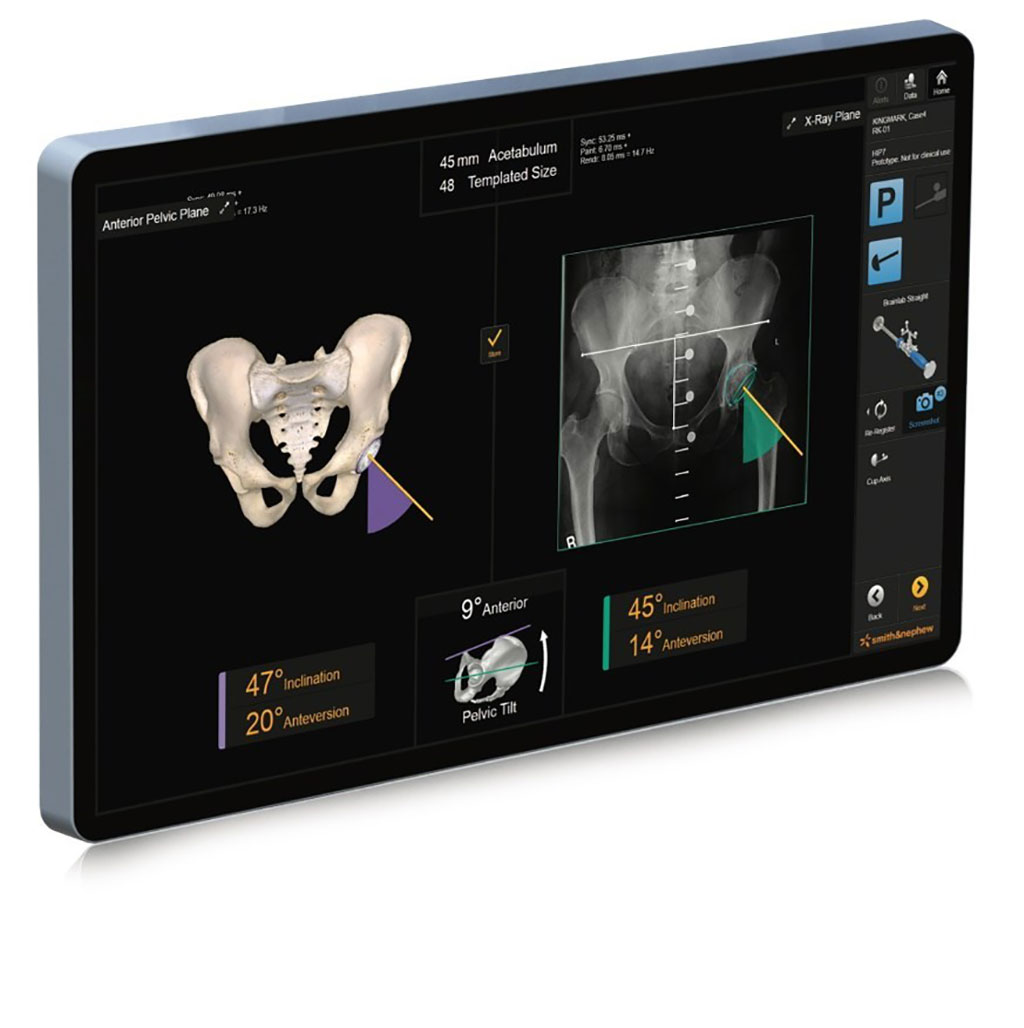 The RI.HIP NAVIGATION system aids hip replacement procedures (Photo courtesy of Smith & Nephew)