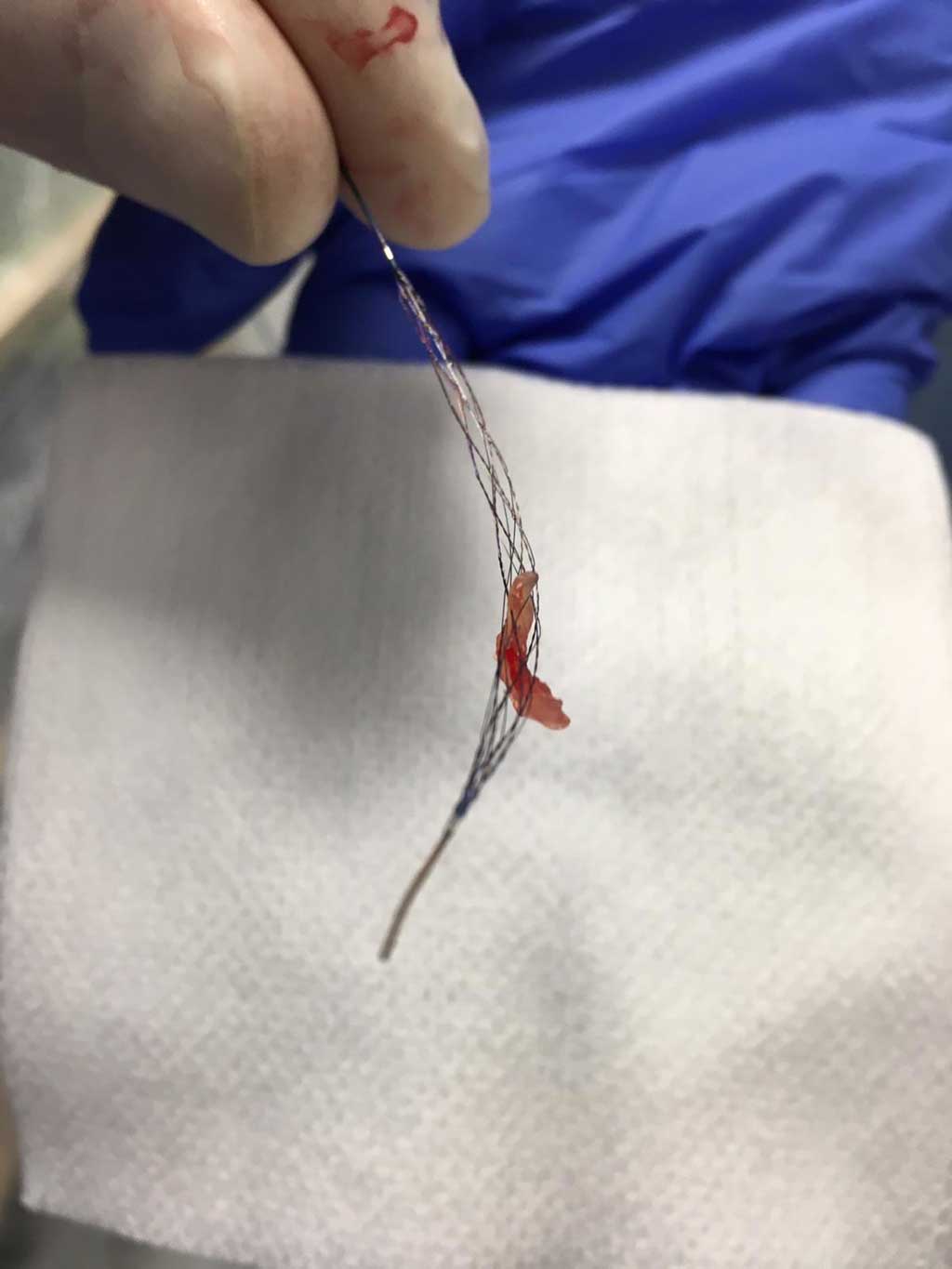: Clot removed with Tigertriever XL at Bochum University Hospital (Photo courtesy of Rapid Medical)