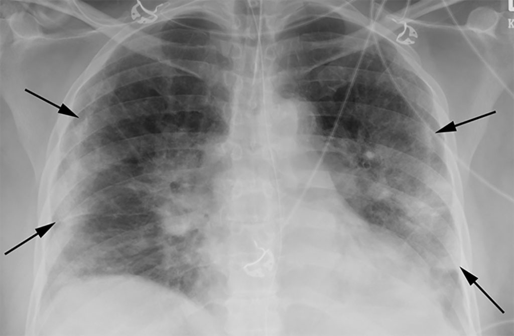 Image: Chest X-Rays Can Aid in Rapid Diagnosis of COVID-19, Find Radiologists (Photo courtesy of LSU Health Sciences Center New Orleans)