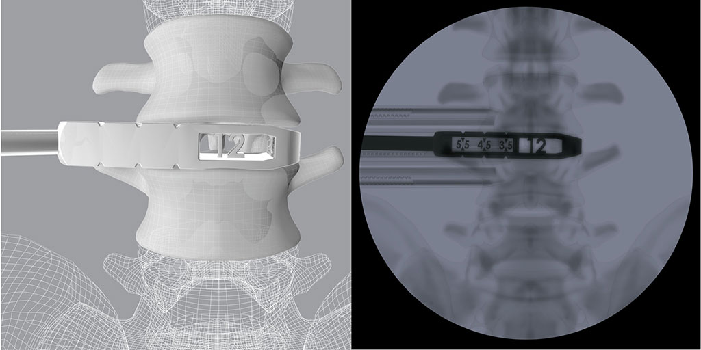 Image: 3D OLIF Trials feature height and length measurements visible only under fluoroscopy (Photo courtesy of CoreLink)