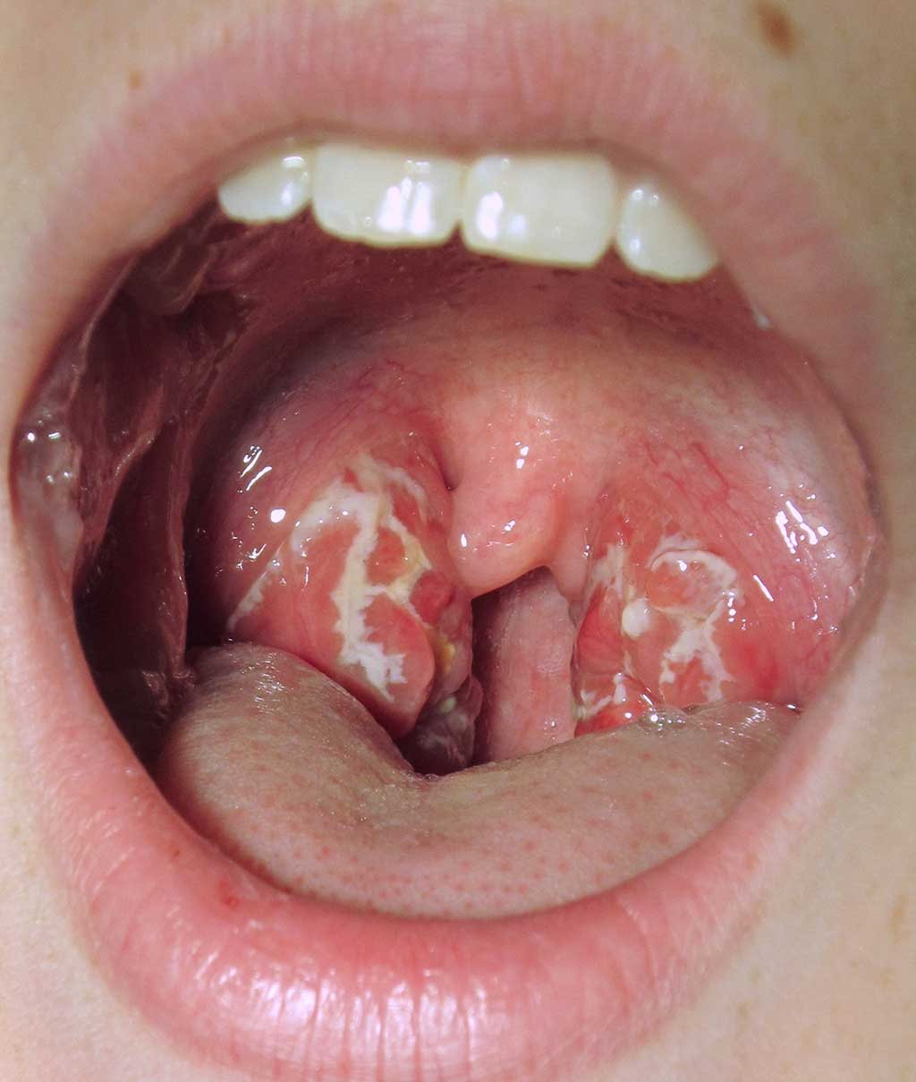 Tonsillotomy Causes Less Morbidity Than Tonsillectomy Surgical Techniques Hospimedica Com