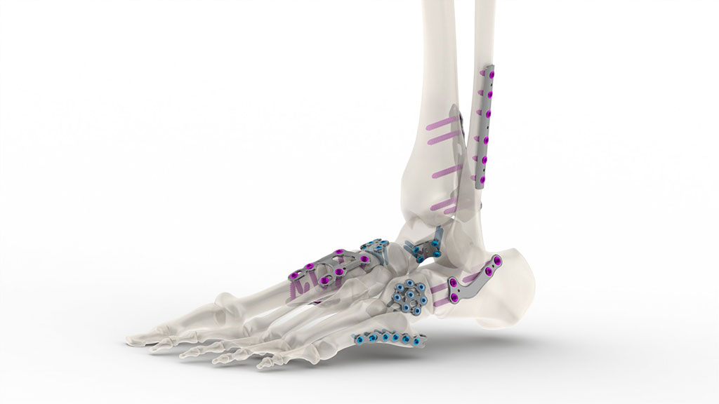 Image: The Tyber Foot and Ankle Plating systems (Photo courtesy of Tyber Medical)